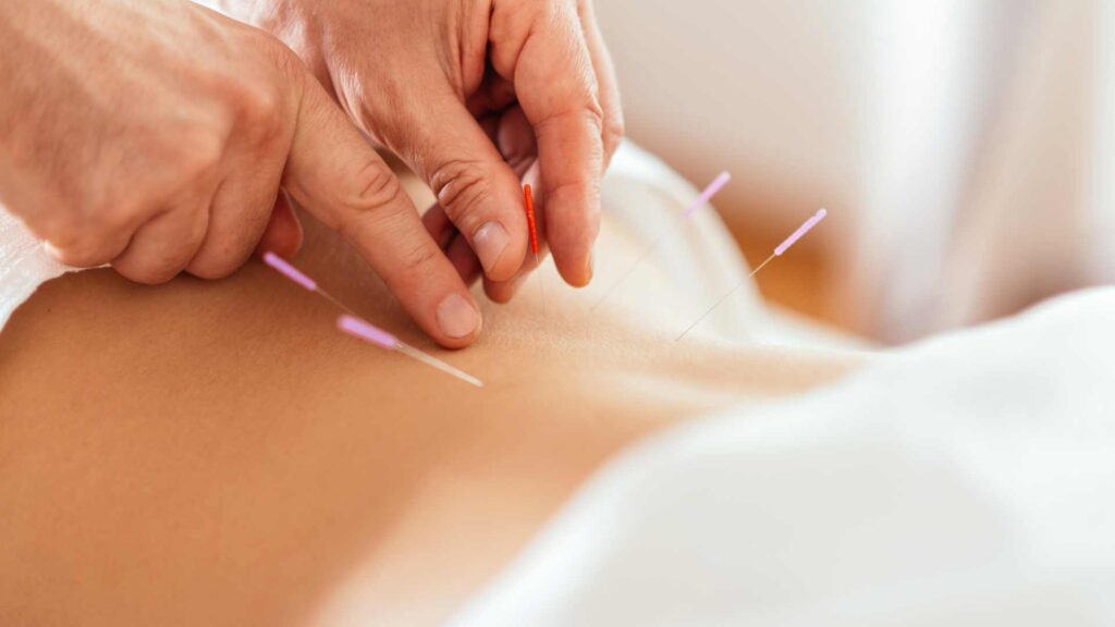 Comment l&rsquo;acupuncture a changé ma routine de beauté : mon histoire